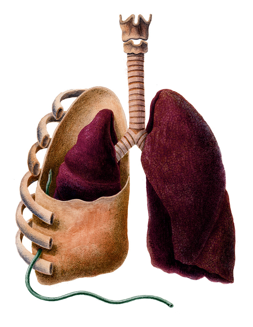 lung anatomy pneumothorax chest tube surgery pleura ruffe fish
