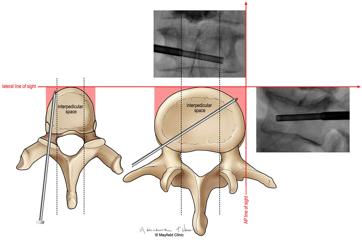 medical illustration spine surgery