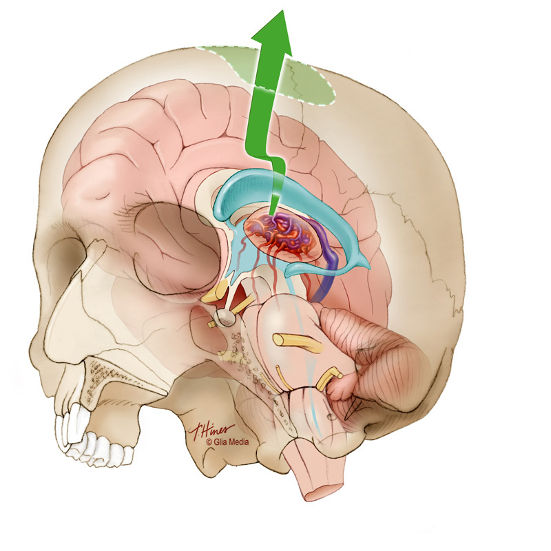 Neurosurgery Brainstem medical illustration brain skull