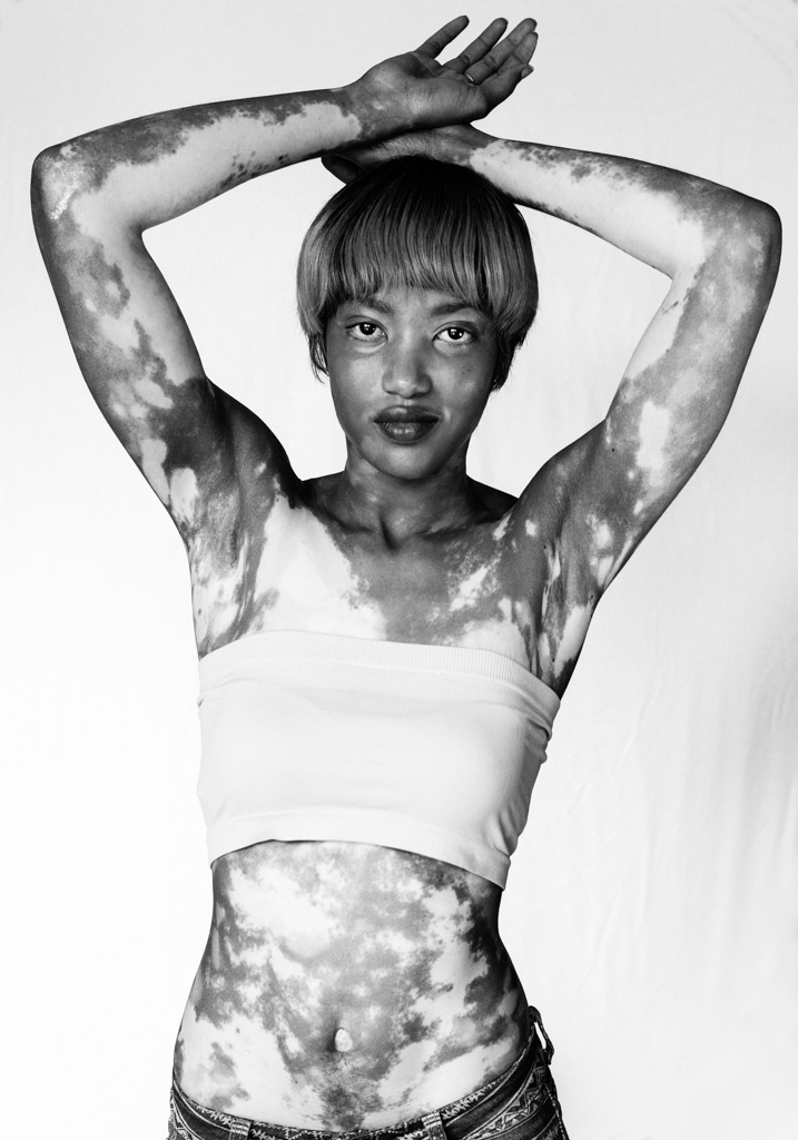 Adobe Portfolio #vitligo #patterns #rolemodel #skin #bielactwo #family #white #black #stigma #pride #Portraits