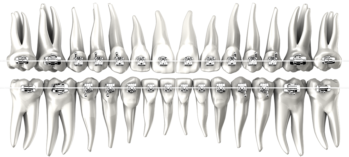 3D Rendering chrome metal braces Brackets orthodontics