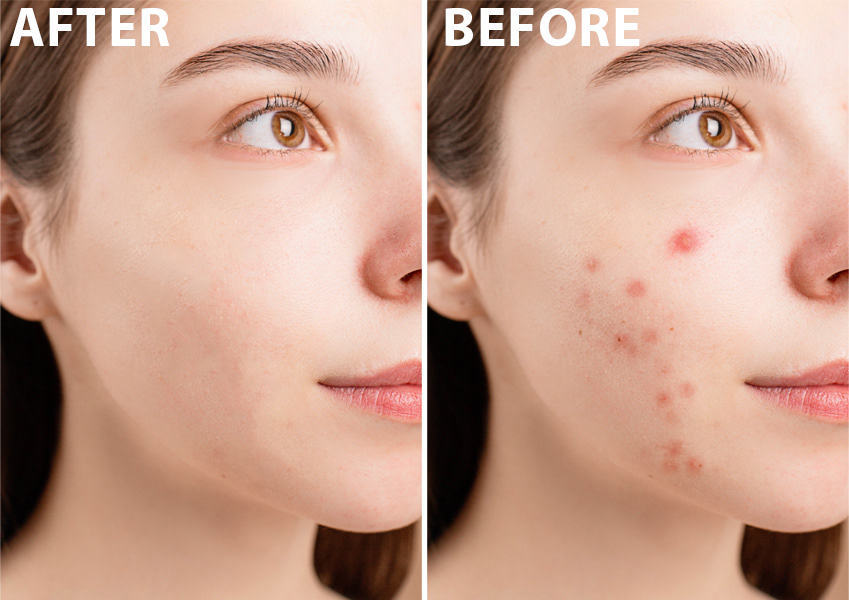face Photo Retouching Editing  Editor Before and After retouch model photoshoot photographer pimple remove