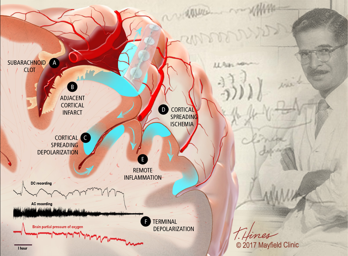 brain medical illustration stroke research