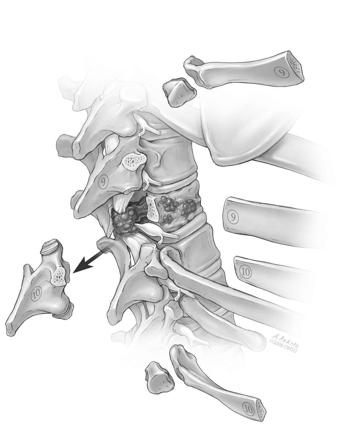 medical illustration spinal tumor