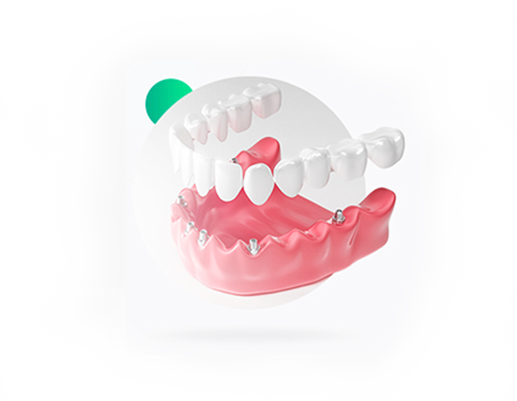 kanatadentalimplants KanataImplantDentures kanataimplants