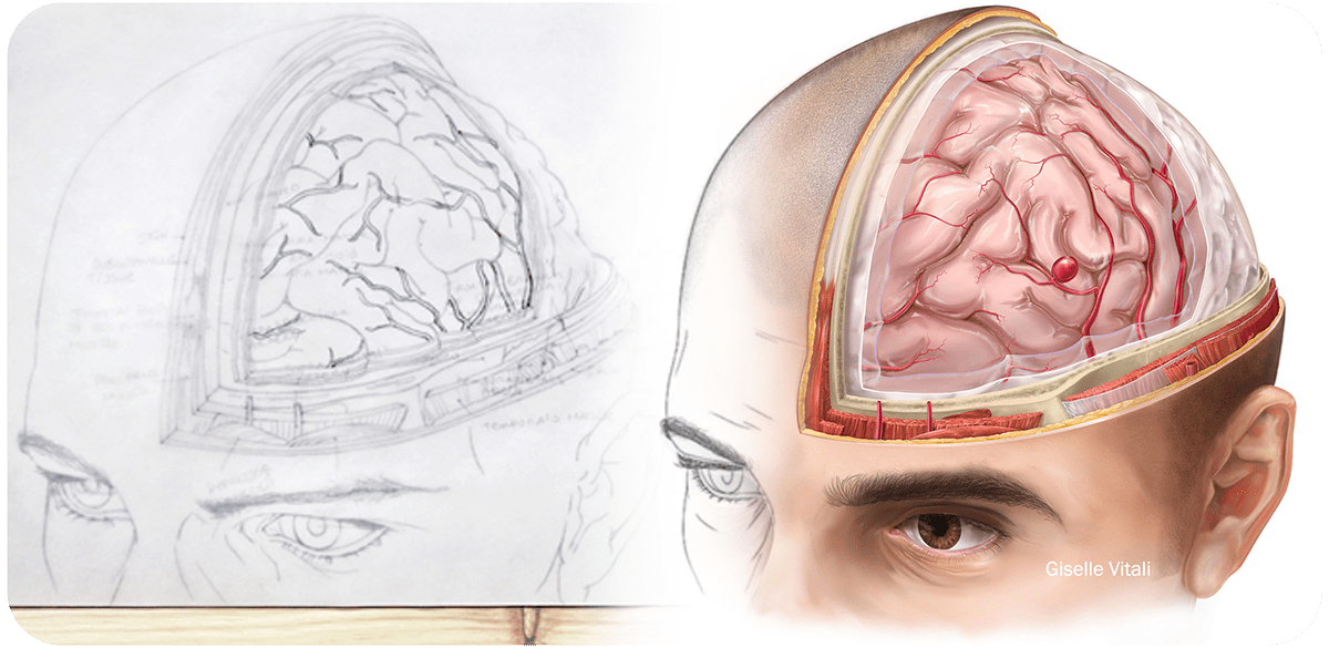 aneurism brain medical art medical illustration