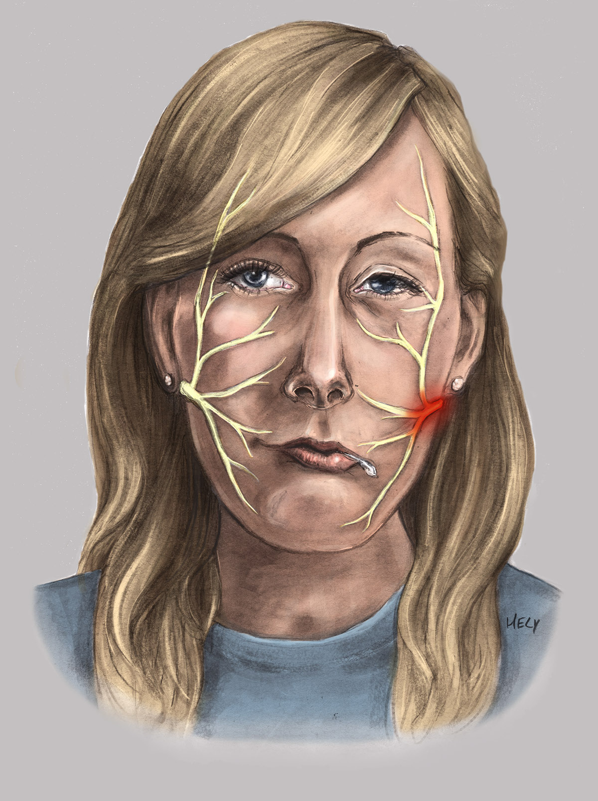 Carbon Dusting  Facial Nerve parotid gland masseter