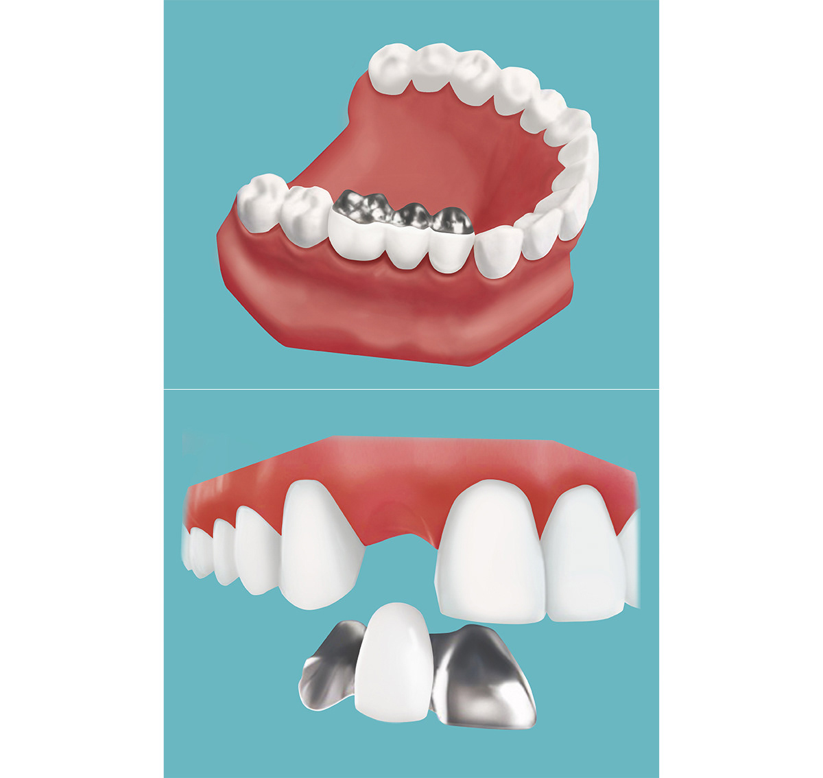 Gebiss Infozeichnung Medizin zähne Zahnmedizin Zahnpflege