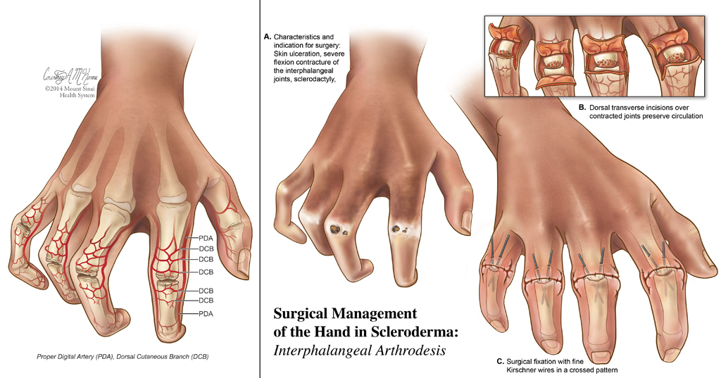medical illustration hand anatomy surgery
