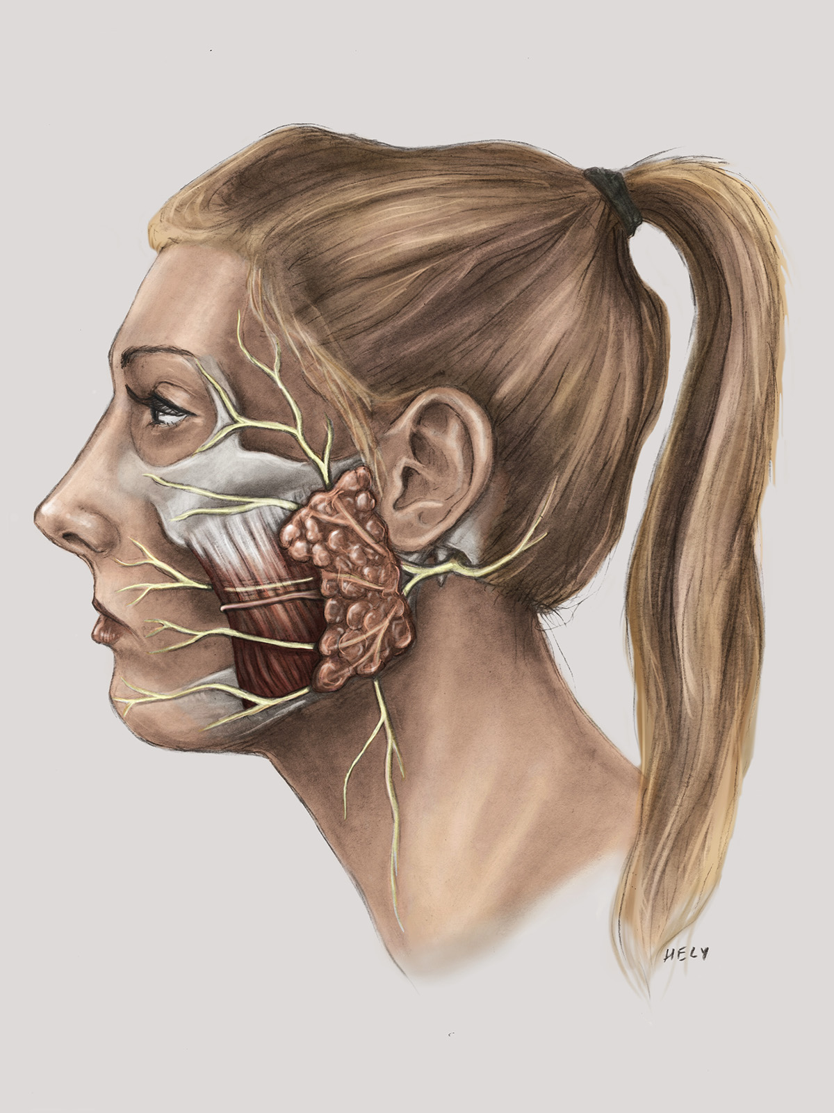 Carbon Dusting  Facial Nerve parotid gland masseter