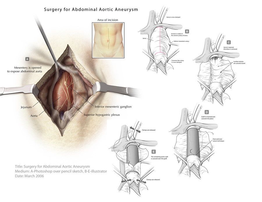 jeremy sherman  medical illustration  medical animation