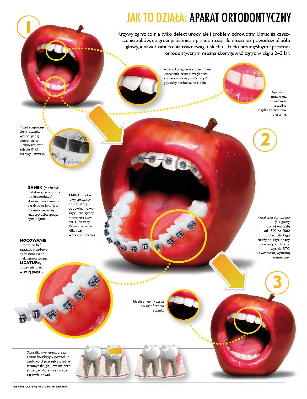 infographics  dental braces  how it