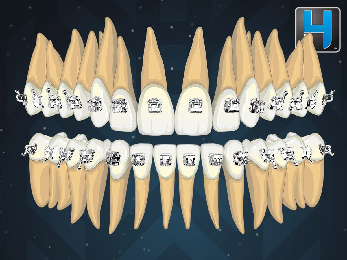 3D Rendering chrome metal braces Brackets orthodontics