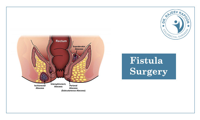 anal fistula surgery in chandigarh