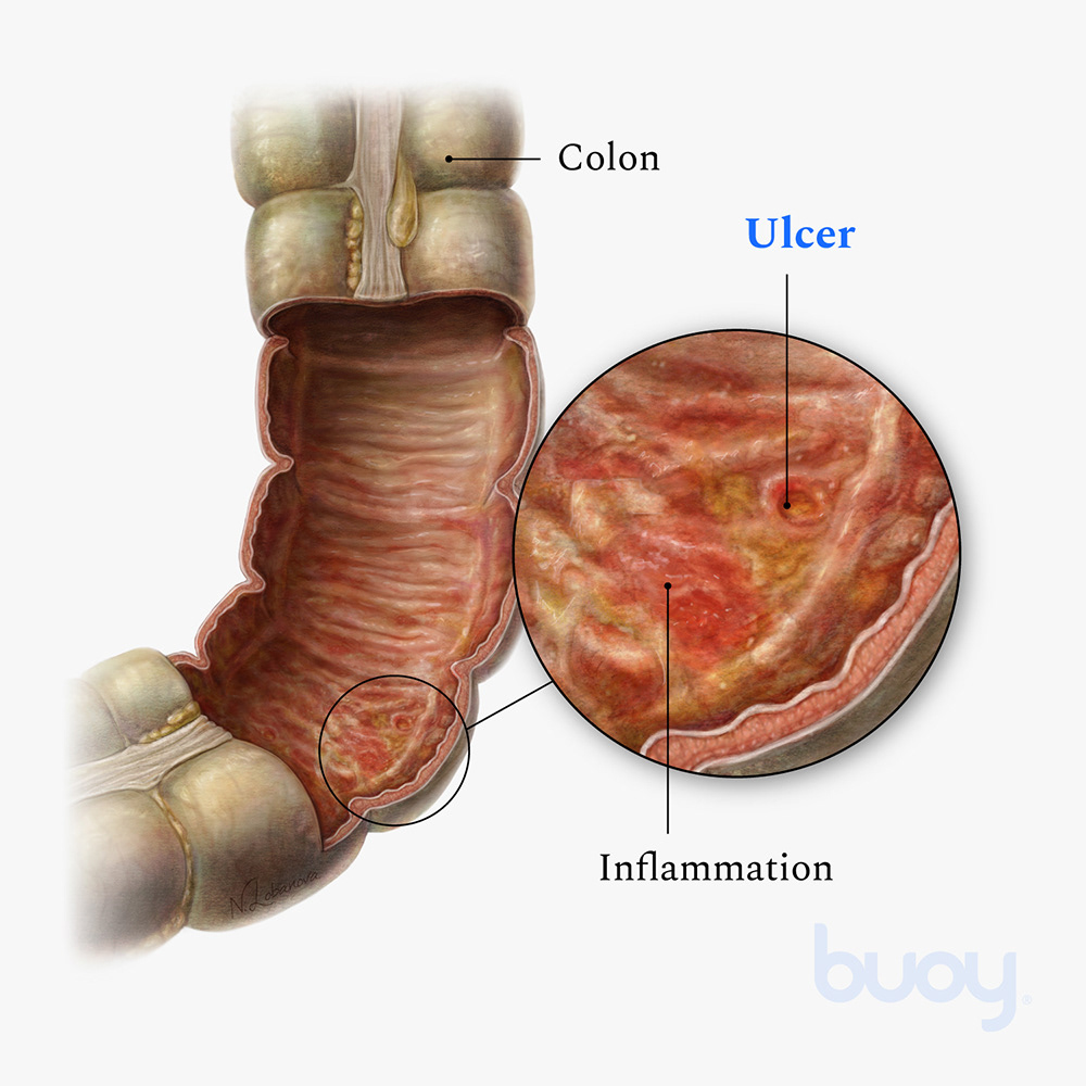 abdomen anatomy Colon Digestive Disease digital inflammation medical illustration pencil SciArt Ulcerative Colitis