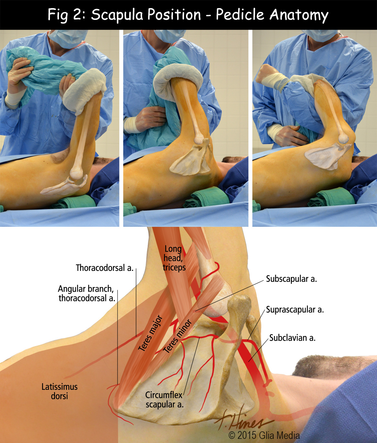 subscapular flap comic surgery