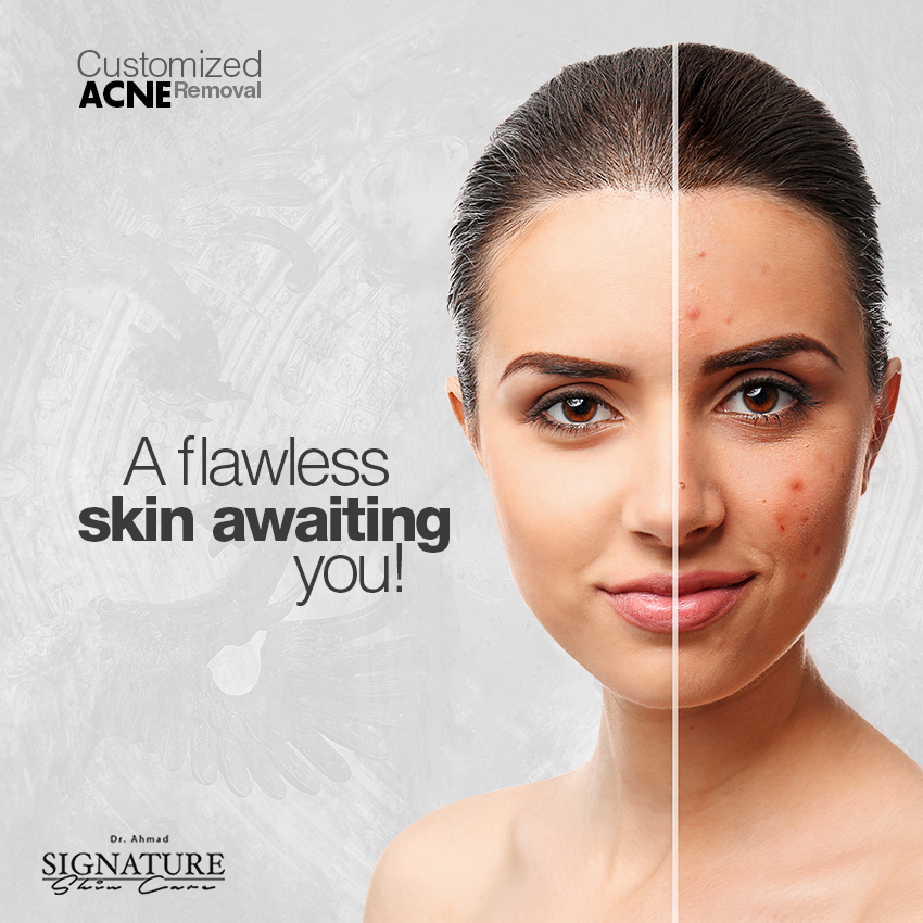 skin laser Treatment color hair growth Fair comlextion acne whitening