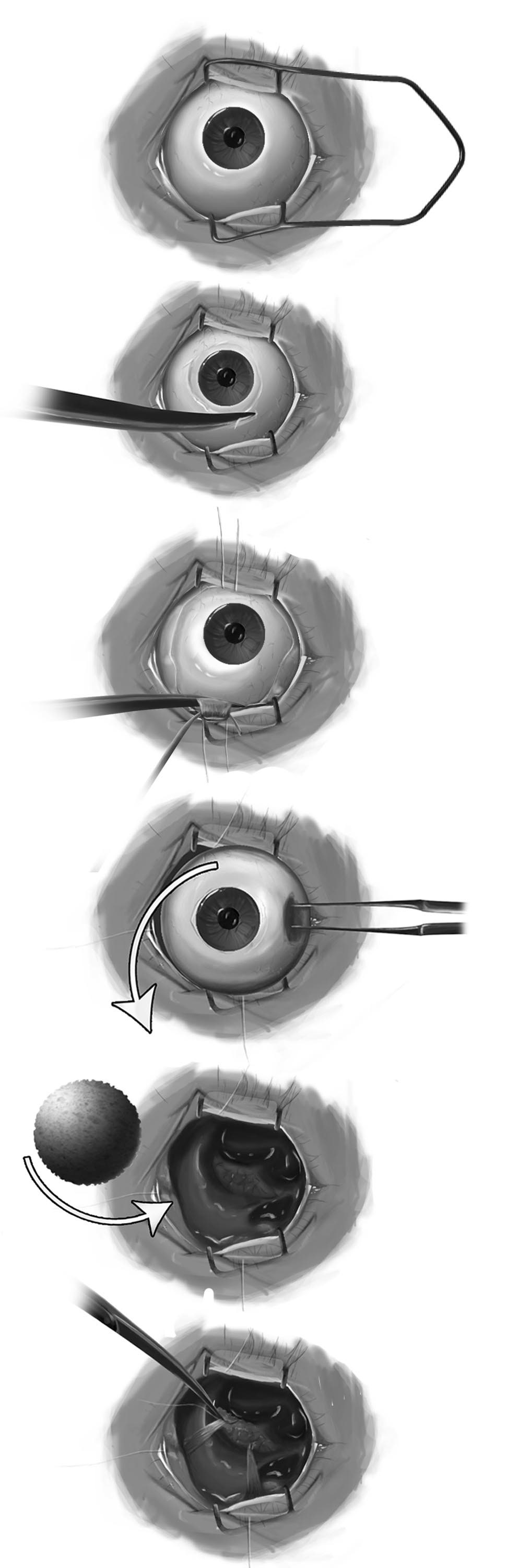 eye surgical medical illustration
