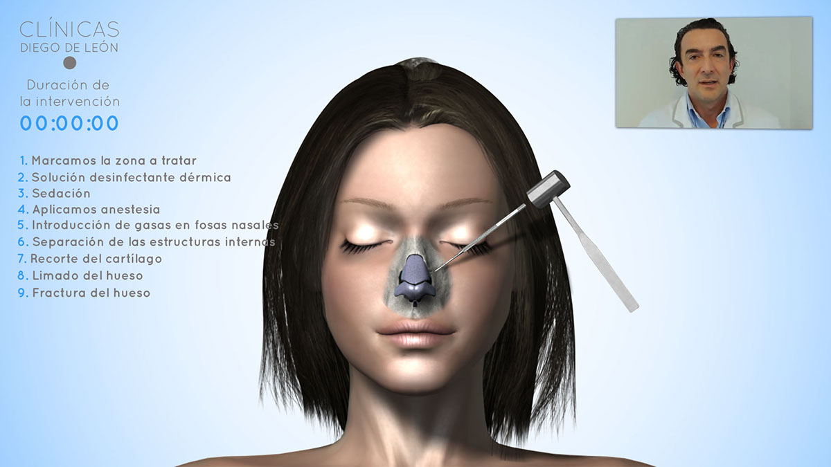 rinoplastia medical clinic nose