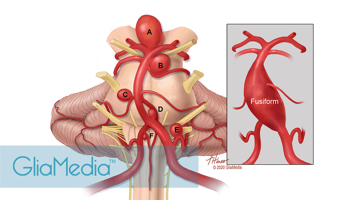 anatomy Aneurysm Brainstem medical illustration Neurosurgery