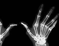 X-Ray of arthritic hands