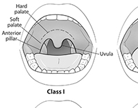 Modified Mallampati Classification System