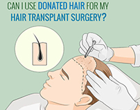 Donated hair for my Hair Transplant Surgery