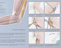 Surgery: Carpal Tunnel Release and Ulnar Nerve Release
