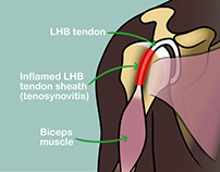Medical illustrations 1: Shoulder anatomy and treatment