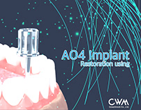 AO4 Implant 3D Restoration using 3D 시뮬에이션영상