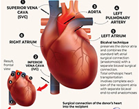 Infographics: Heart transplant