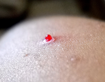Blood Filled Pimple: How To Recognize And Treat