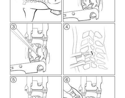 Intervertebral Disc Repair - Medical Illustration