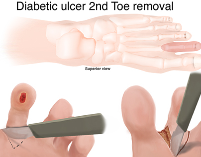 Diabetic Ulcer 2nd toe removal