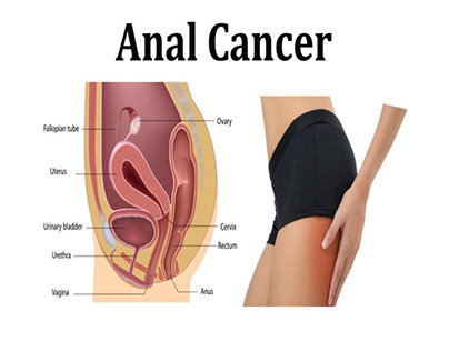 ANAL CANCER : CAUSES, SYMPTOMS AND TREATMENT