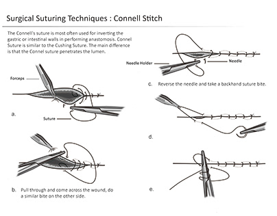 Surgical Suturing Techniques