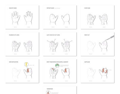 Illustrations for a syndactyly pediatric surgery