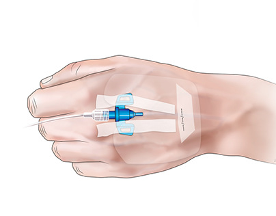 Intravenous catheter inserted