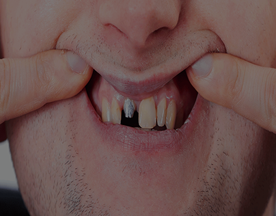 What Is Permanent Teeth Implants Procedure?