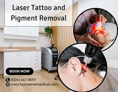Laser Tattoo and Pigment Removal