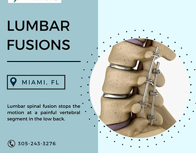 Lumbar Spinal Fusion in Miami