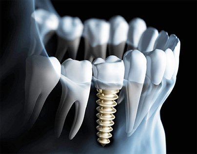 Dental implant clinic in Paschim vihar