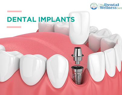 Restore Your Smile: Premier Dental Implants