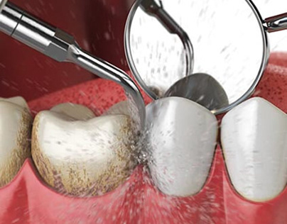 Benefits and Types of Deep Dental Cleaning