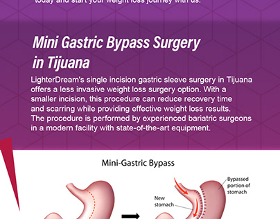 Mini Gastric Bypass Surgery in Tijuana