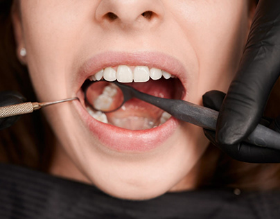 Decoding the Process to Smooth Wisdom Tooth Removal