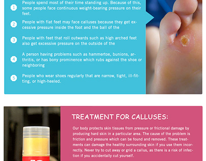Simple Tips To Care And Treat Foot Calluses