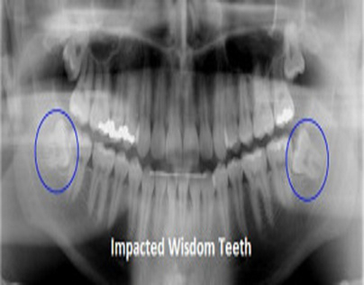 Top 4 Reasons to Remove Wisdom Teeth