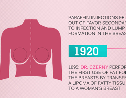 Infographic of History of breast Implantation