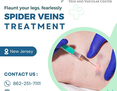 Expert Spider Vein Treatment in NJ